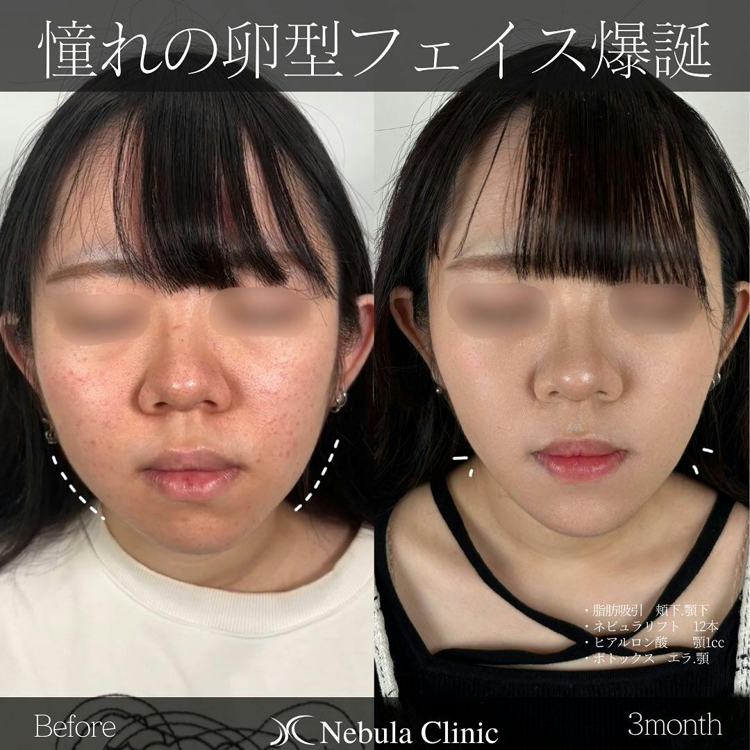 【女性・顔・頬下・顎下・顎・エラ】脂肪吸引(頬下・顎下)、糸リフト、ヒアルロン酸(顎)、ボトックス(エラ・顎)_before_aftar