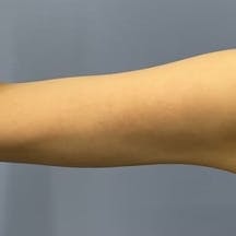 【女性・二の腕】美ボディ脂肪吸引_after