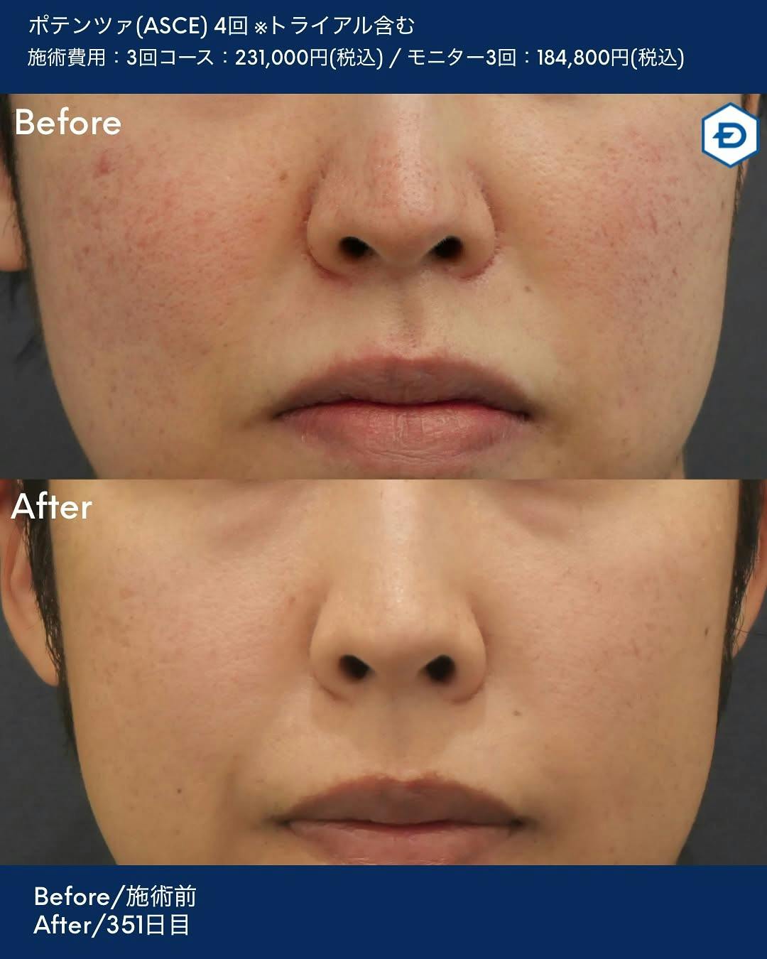 【男性・赤み】ポテンツァ(ASCE)_before_aftar