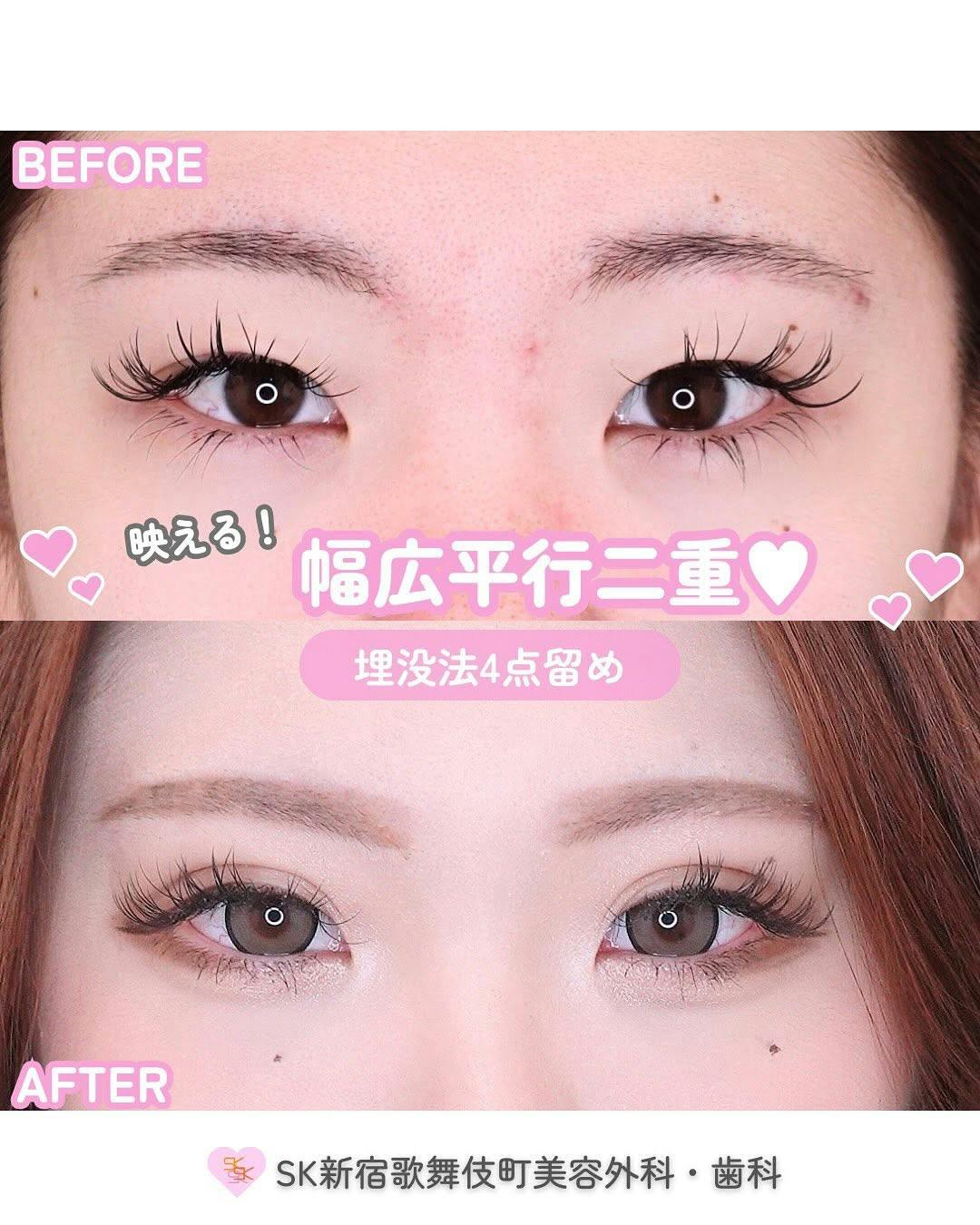 【女性・目元】二重埋没4点留め_before_aftar