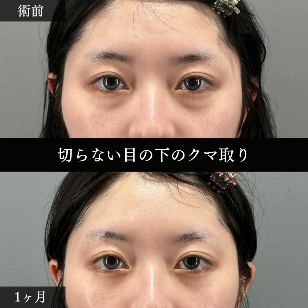 【20代女性・目】切らない目の下のクマ取り_before_aftar