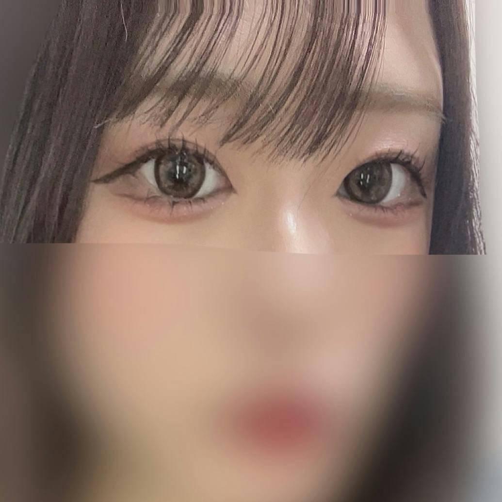 TCB東京中央美容外科 福岡天神院で二重整形・二重埋没・目頭・蒙古ひだ切開を受けたみゃんさんの写真