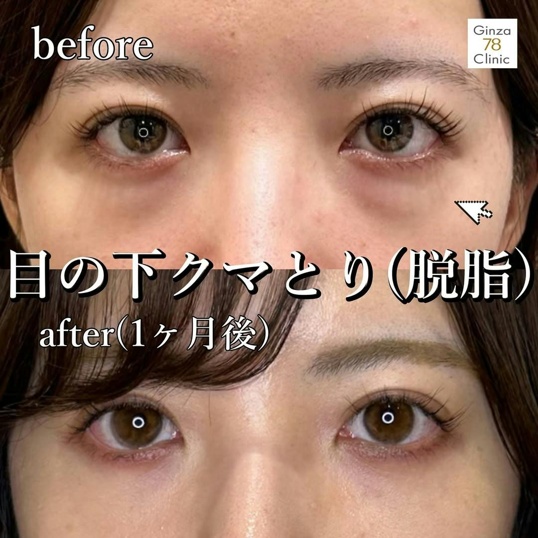 【女性・目元】目の下のクマ取り_before_aftar