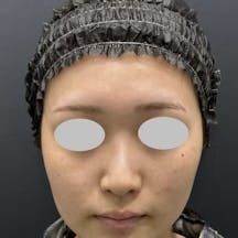 【20代女性・鼻】鼻尖部軟骨移植 鼻尖形成/鼻尖形成3D法(だんご鼻解消術)_before