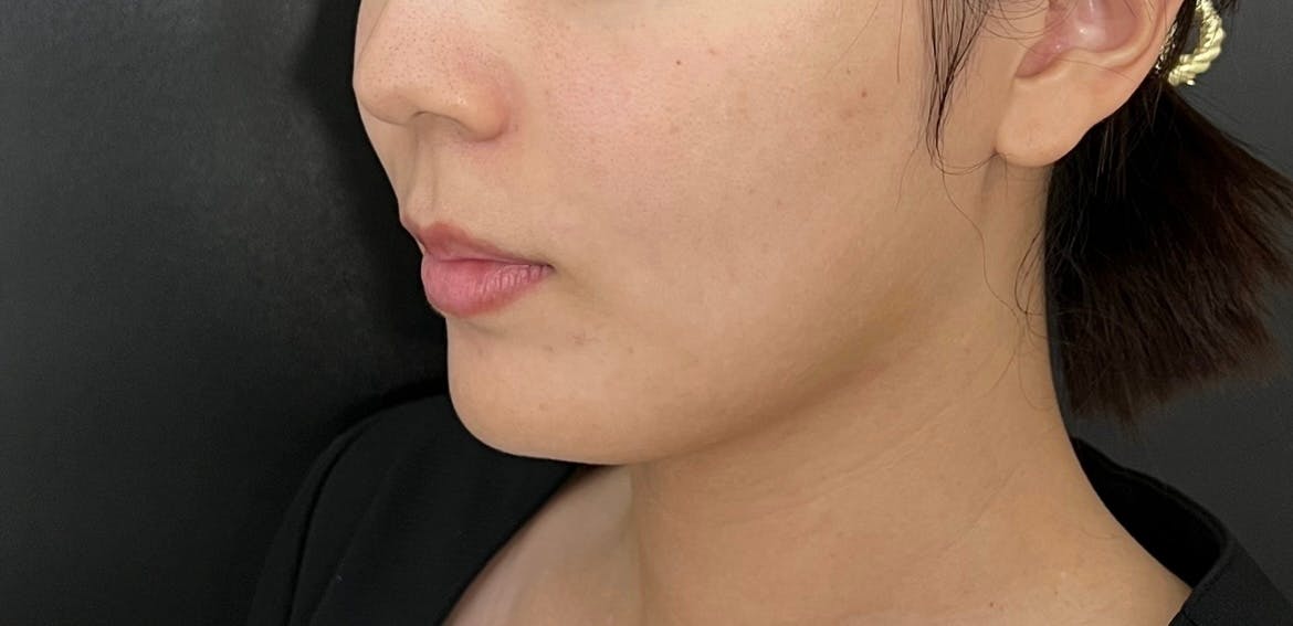 L’or Clinic Omotesando 札幌院（ロールクリニックオモテサンドウ）で顎下の脂肪吸引を受けたちょもさんの写真