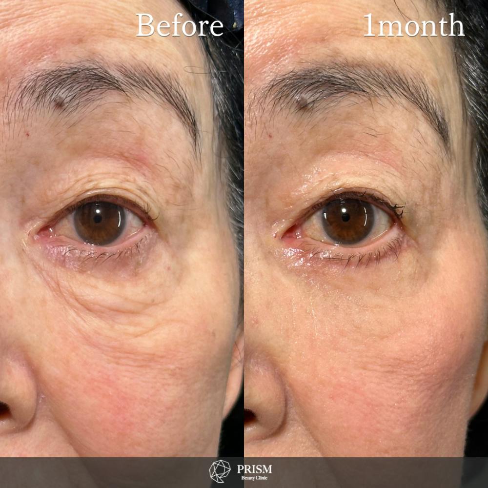 【70代女性・目】目の下のたるみ取り(下眼瞼除皺術)_before_aftar