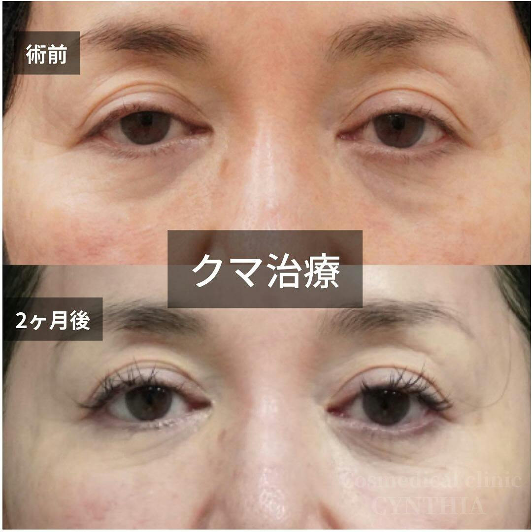 【50代女性・目元】目の下のクマ取り_before_aftar