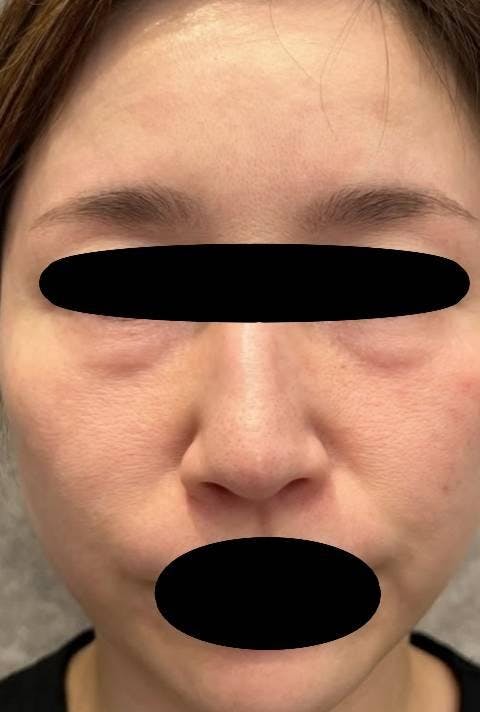 TCB東京中央美容外科 新宿東口院で目の下のクマ・たるみ・しわ取り：クマ取り再生注射を受けたGenieさんの写真
