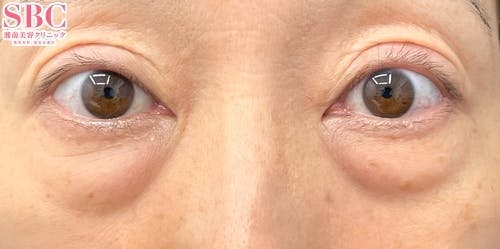 【目元】切開ハムラ(表ハムラ)法、ナチュラル脂肪注射ナノリッチ_before