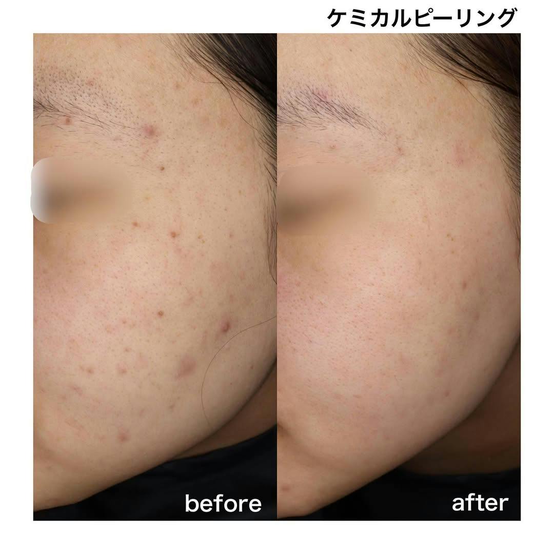 【女性・顔】ケミカルピーリング_before_aftar