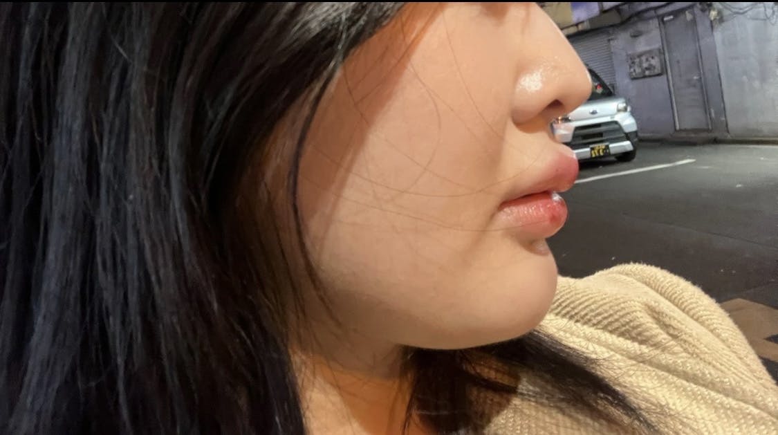 東京秘密クリニック 渋谷院でインモードvリフティングを受けたののさんの写真