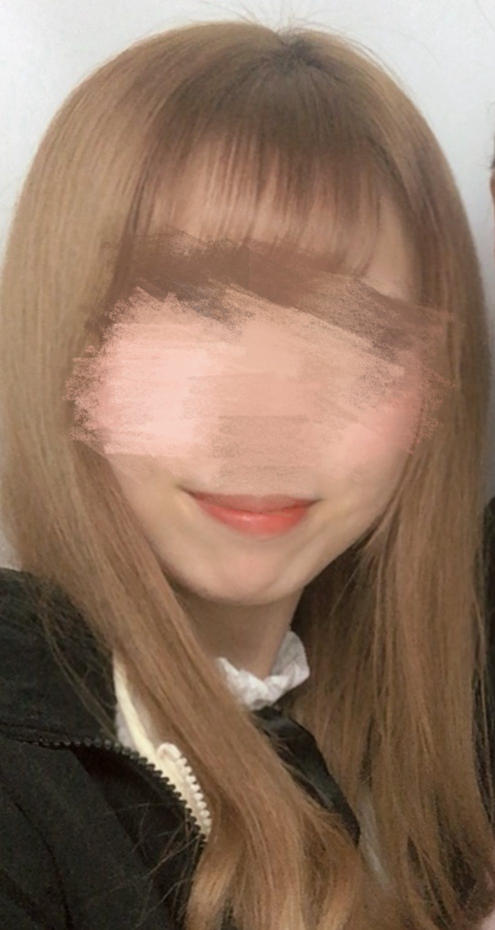 レナトゥスクリニック 東京田町院で顎ヒアルロン酸を受けたすてらさんの写真