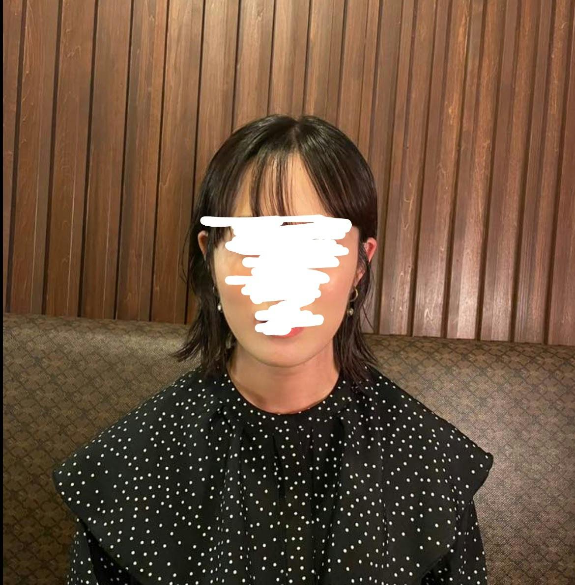 湘南美容クリニック 神戸三宮院でボトックス注射・エラボトックス注射(小顔)・韓国製ボトックス・ボツリヌストキシン・アラガン製ボトックスを受けたむぎちゃんさんの写真