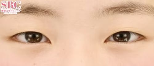 【10代女性・目元】クイックコスメティーク・ダブルNeo_before