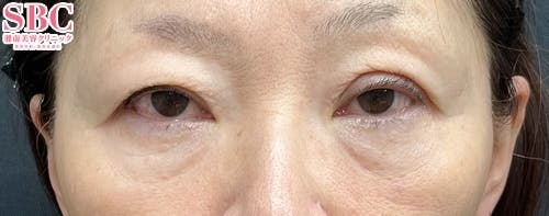 【50代女性・目元】ナチュラル脂肪注射コンデンスリッチ、ナチュラル脂肪注射ナノリッチ、目の下の切らないクマ・たるみ（ふくらみ）取り_before