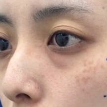 【女性・クマ】目の下の切らないクマ・たるみ(ふくらみ)取り ナチュラル脂肪注射コンデンスリッチ_before