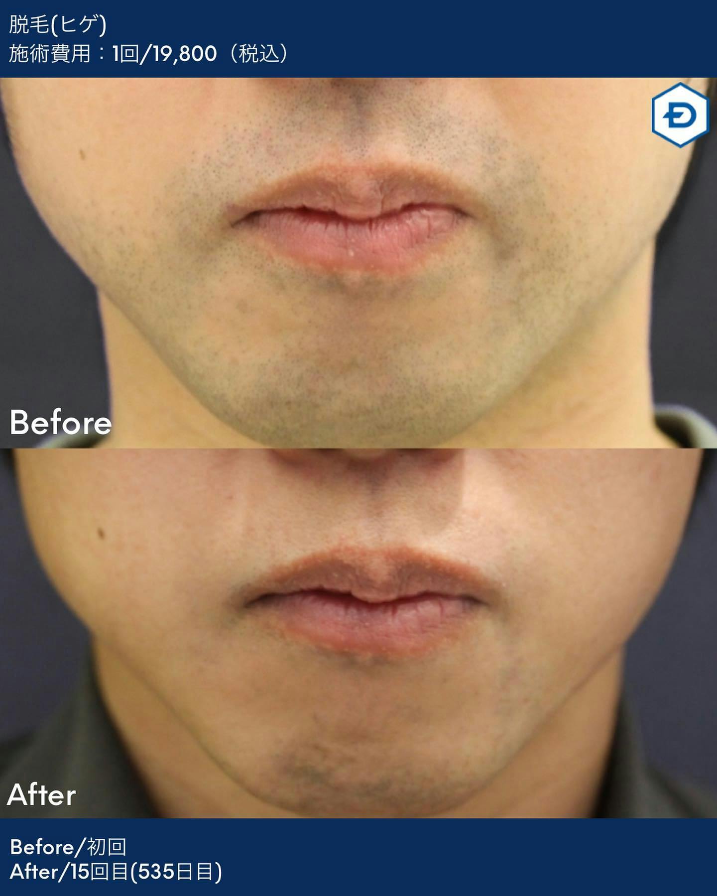 【男性・ヒゲ】脱毛(ヒゲ)_before_aftar