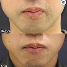 【男性・ヒゲ】脱毛(ヒゲ)_before_aftar