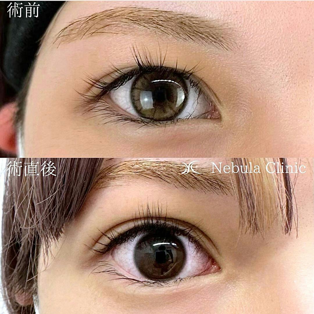 【女性・目元】二重埋没法_before_aftar