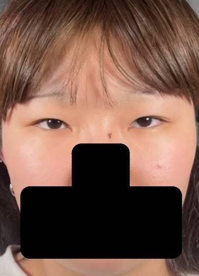 品川スキンクリニック 新宿院で二重まぶた・目元の整形：スーパーナチュラル二重術切開法を受けたSHIZUKIさんの写真