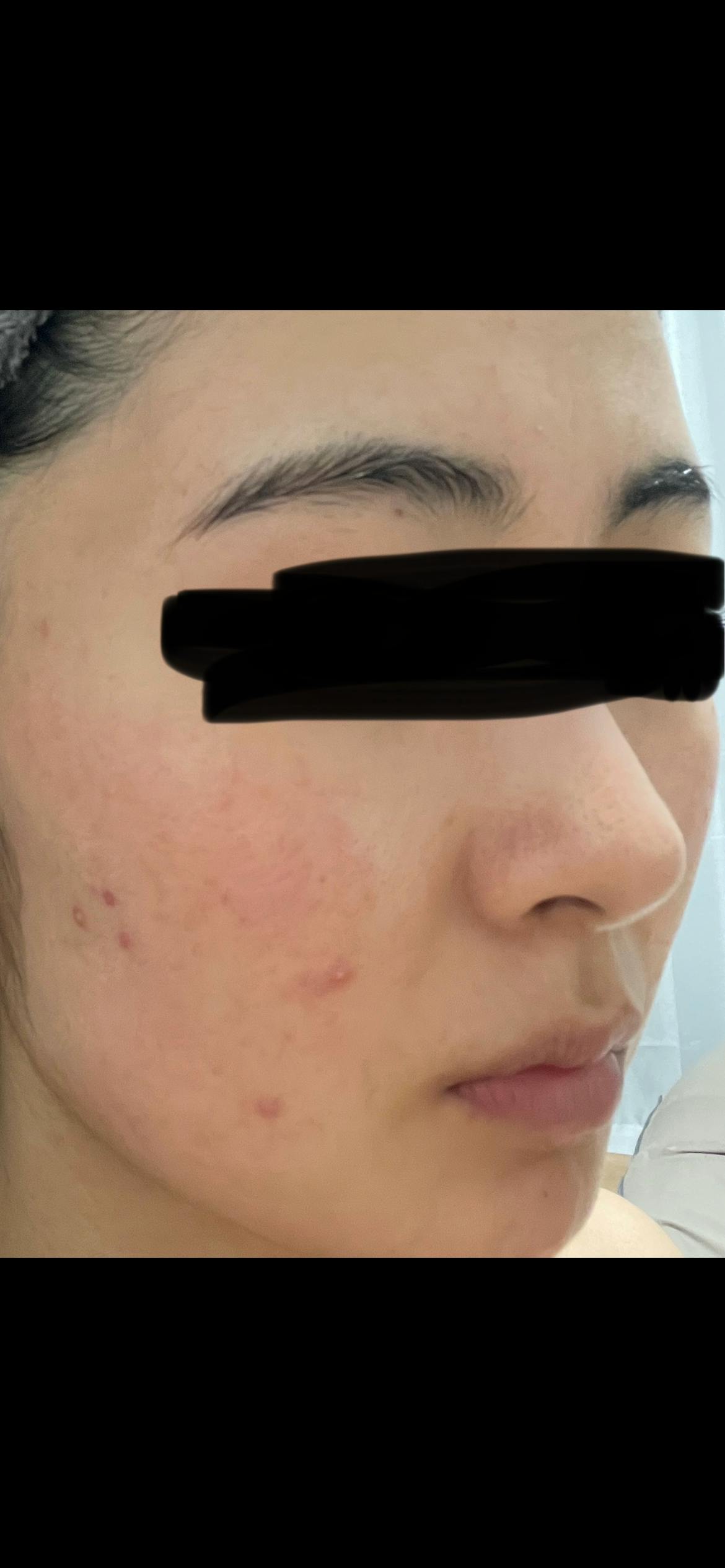 渋谷美容外科クリニック 横浜院でケミカルピーリングを受けたははるさんの写真