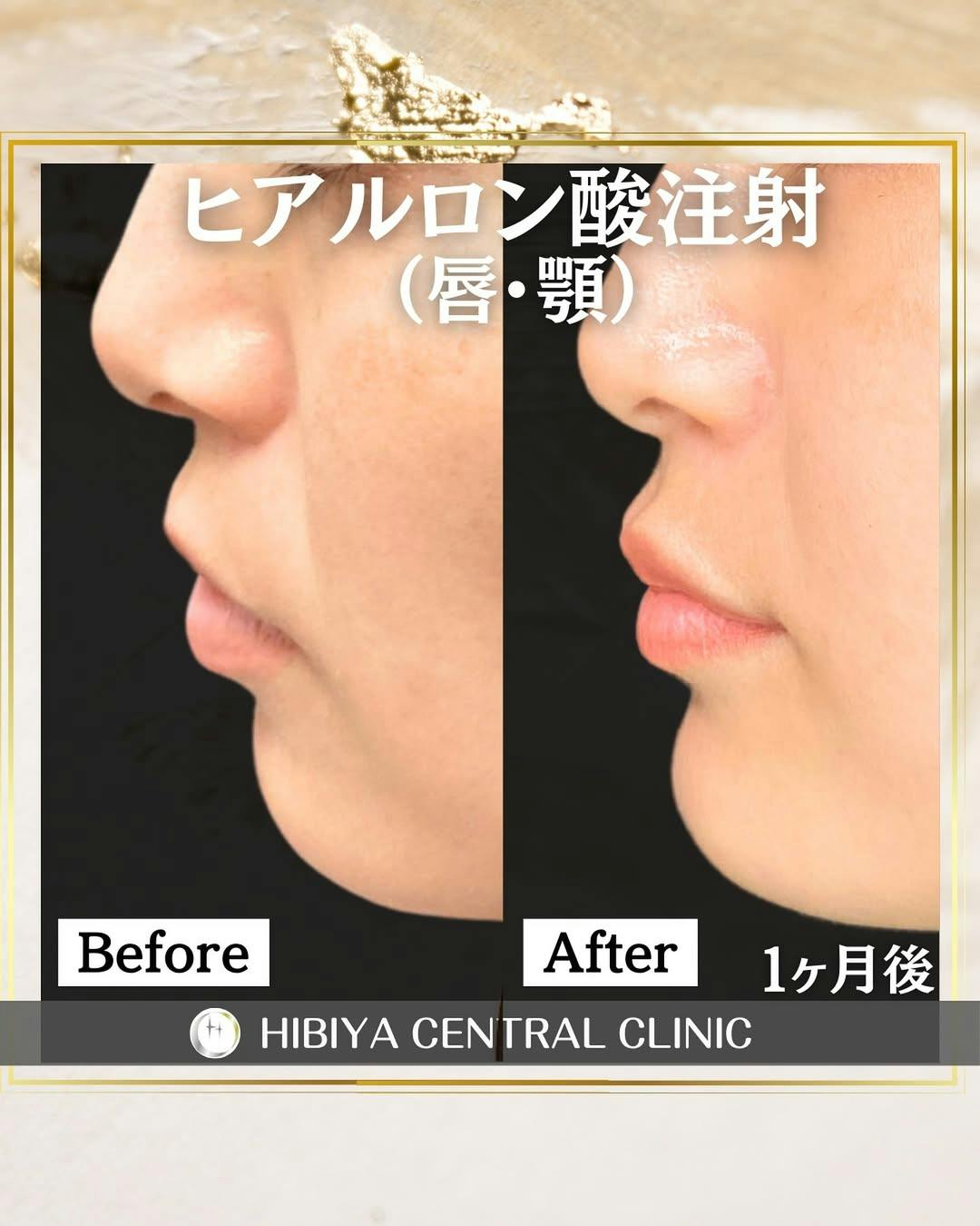 【女性・くぼみ】ヒアルロン酸注射_before_aftar