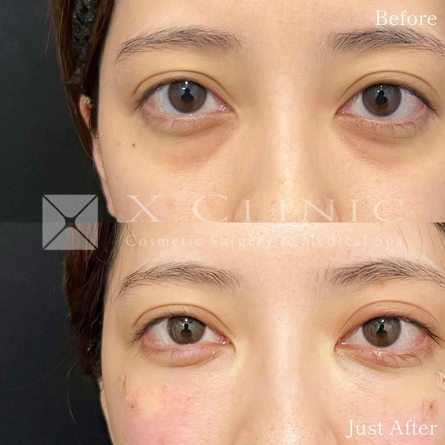 【20代女性・目元】クマ取りフルコース＋エクソソーム_before_aftar