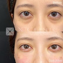 【20代女性・目元】クマ取りフルコース+エクソソーム_before_aftar