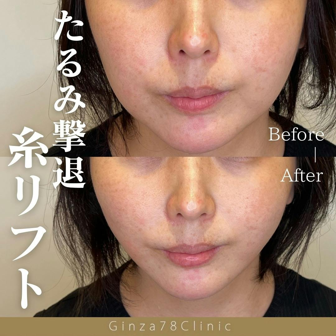 【女性・たるみ】糸リフト_before_aftar