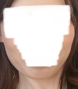 TCB東京中央美容外科 新宿東口院でを受けたminさんの写真