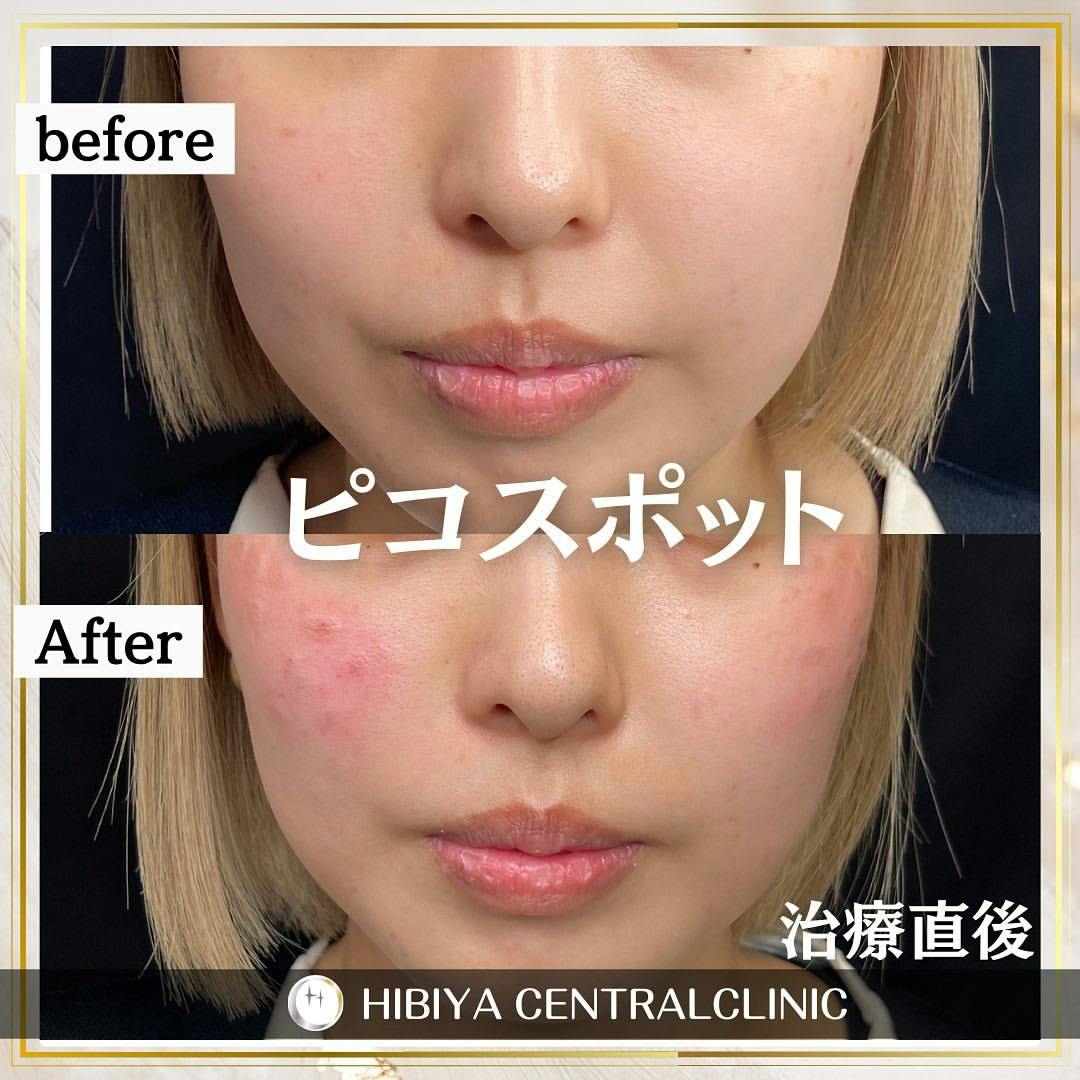 【女性・シミ】ピコスポット_before_aftar
