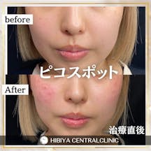 【女性・シミ】ピコスポット_before_aftar