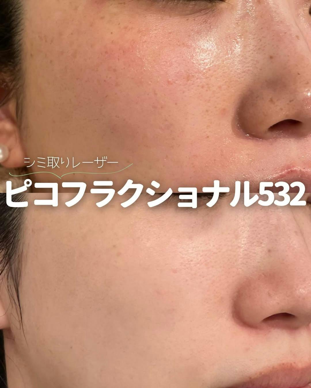 【女性・シミ】ピコフラクショナル532_before_aftar