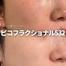 【女性・シミ】ピコフラクショナル532_before_aftar