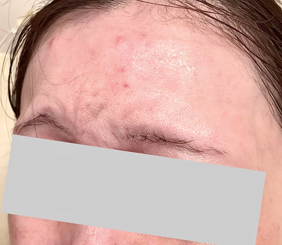 目の下のクマ・たるみ取り・ボトックス注射・顎のボトックス注射・目尻ボトックス注射・眉間ボトックス注射・目の下ボトックス注射・おでこ(額)ボトックス注射 ・バニーライン・鼻根ボトックス注射・韓国製ボトックス・ボツリヌストキシン・クマ取り注射・アラガン製 ..., image size:1106x959