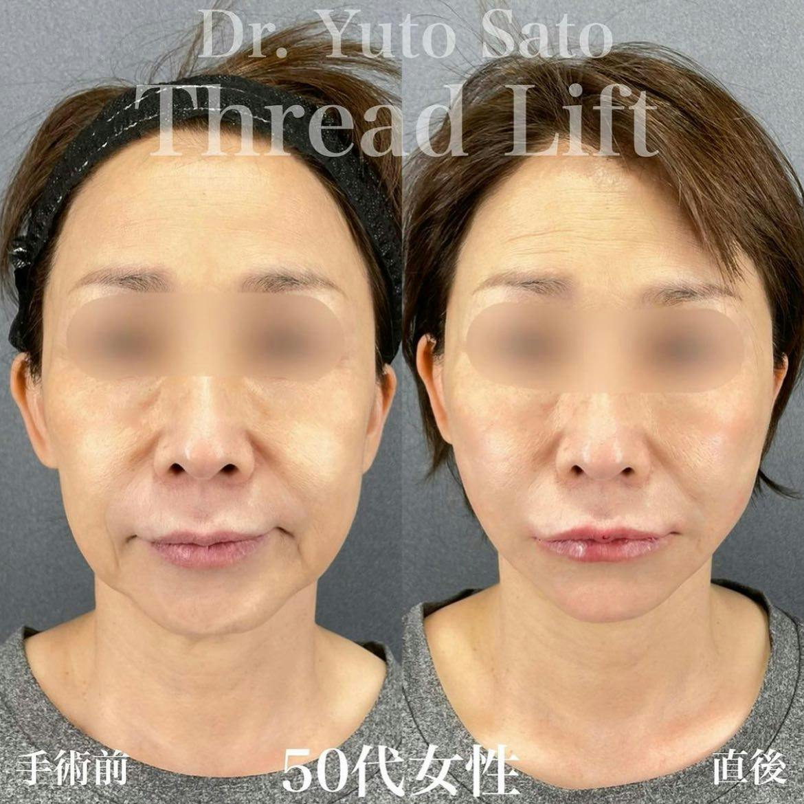 【50代女性・たるみ】糸リフト ヒアルロン酸_before_aftar