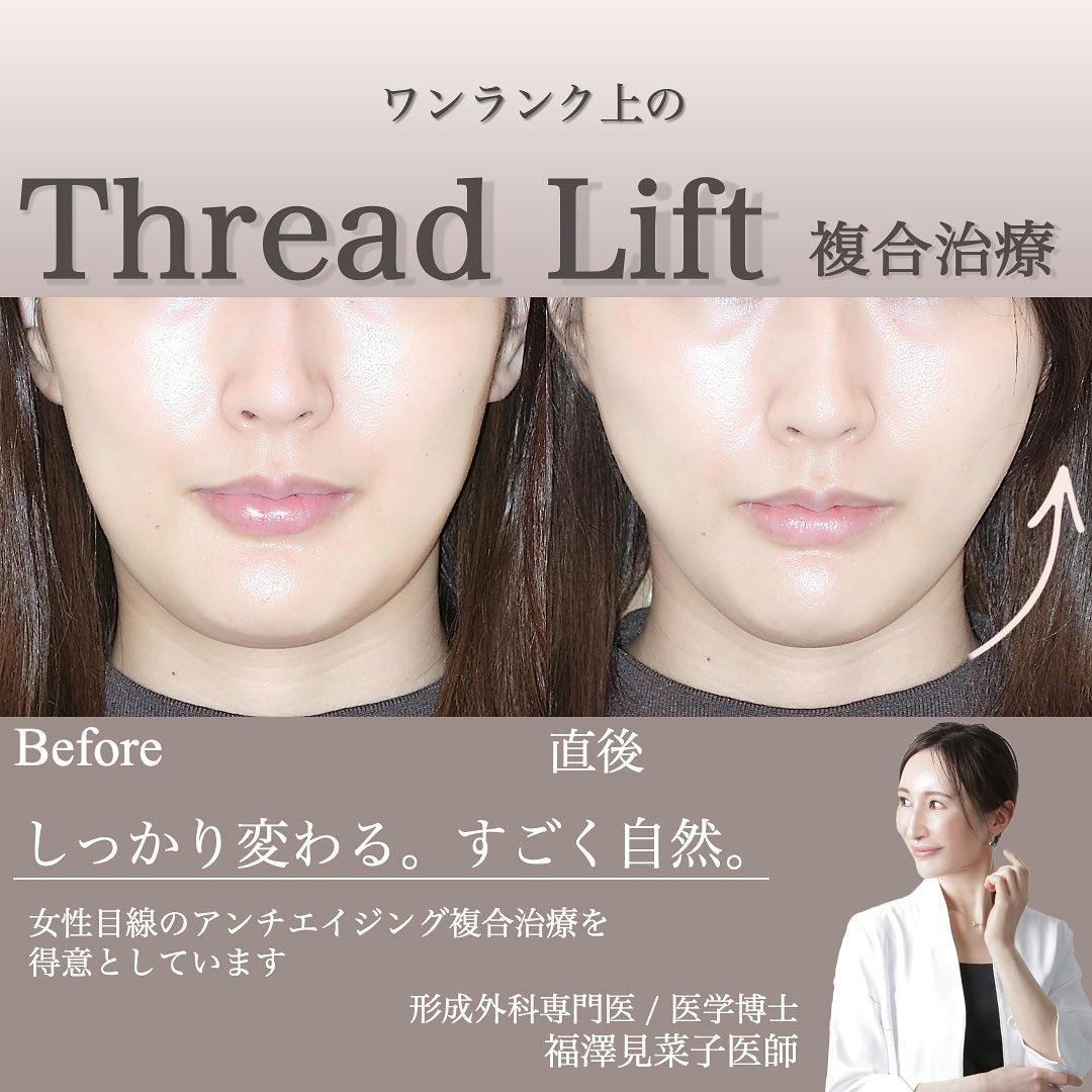 【女性・輪郭】糸リフト、エラボトックス_before_aftar