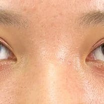 【10代女性・目元】Teen二重(R)、自然癒着法_after