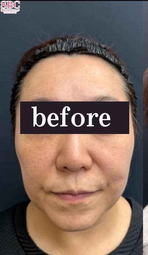 【60代女性・小顔】美ボディ脂肪吸引、その他の治療法_before