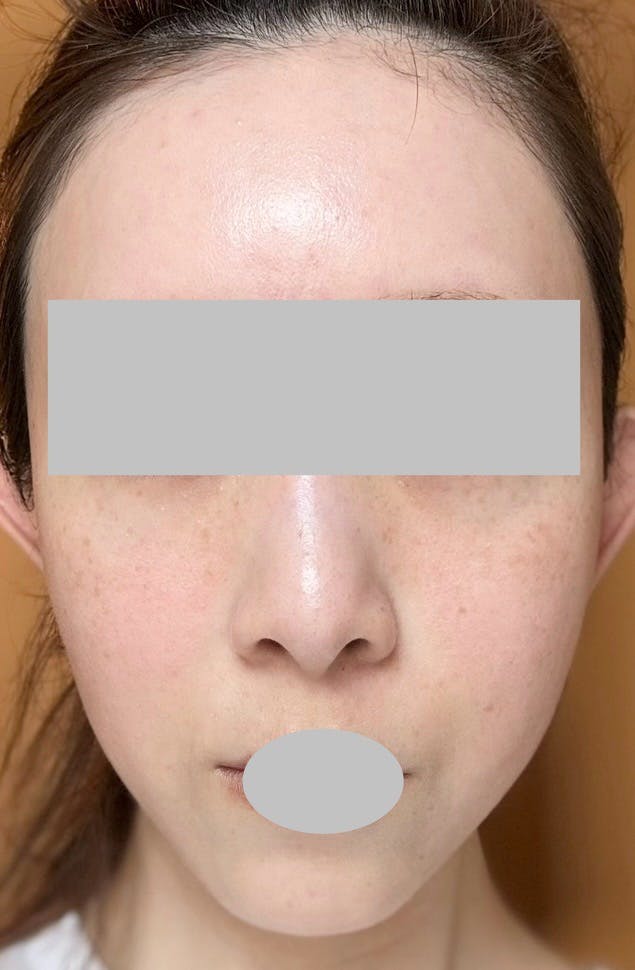 ピュアビューティー恵比寿(PURE BEAUTY)でマッサージピール(コラーゲンピール)を受けたarai03さんの写真