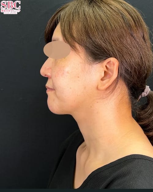 【女性・小顔】根こそぎVASER脂肪吸引_after