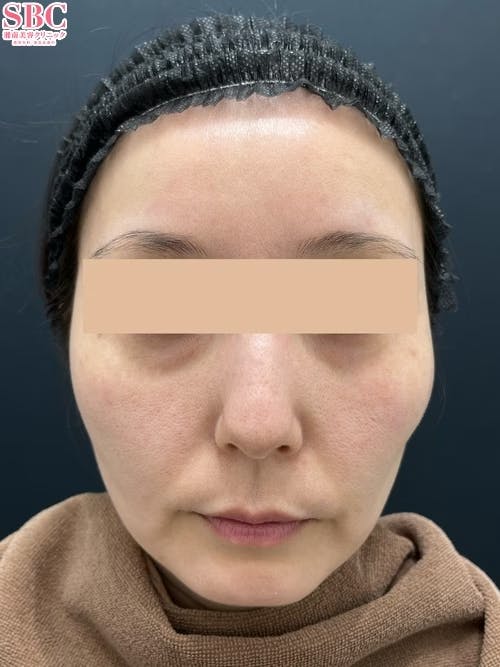 【女性・顔】VOV(ボブ)リフト_before