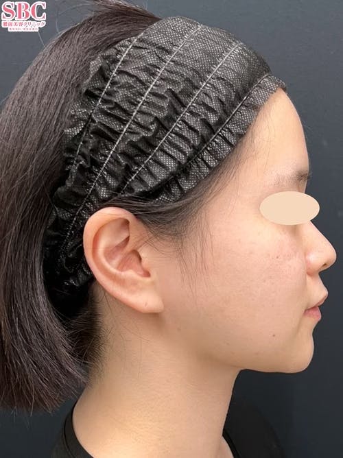 【20代女性・顔】小顔用脂肪吸引注射、バッカルファット除去_after