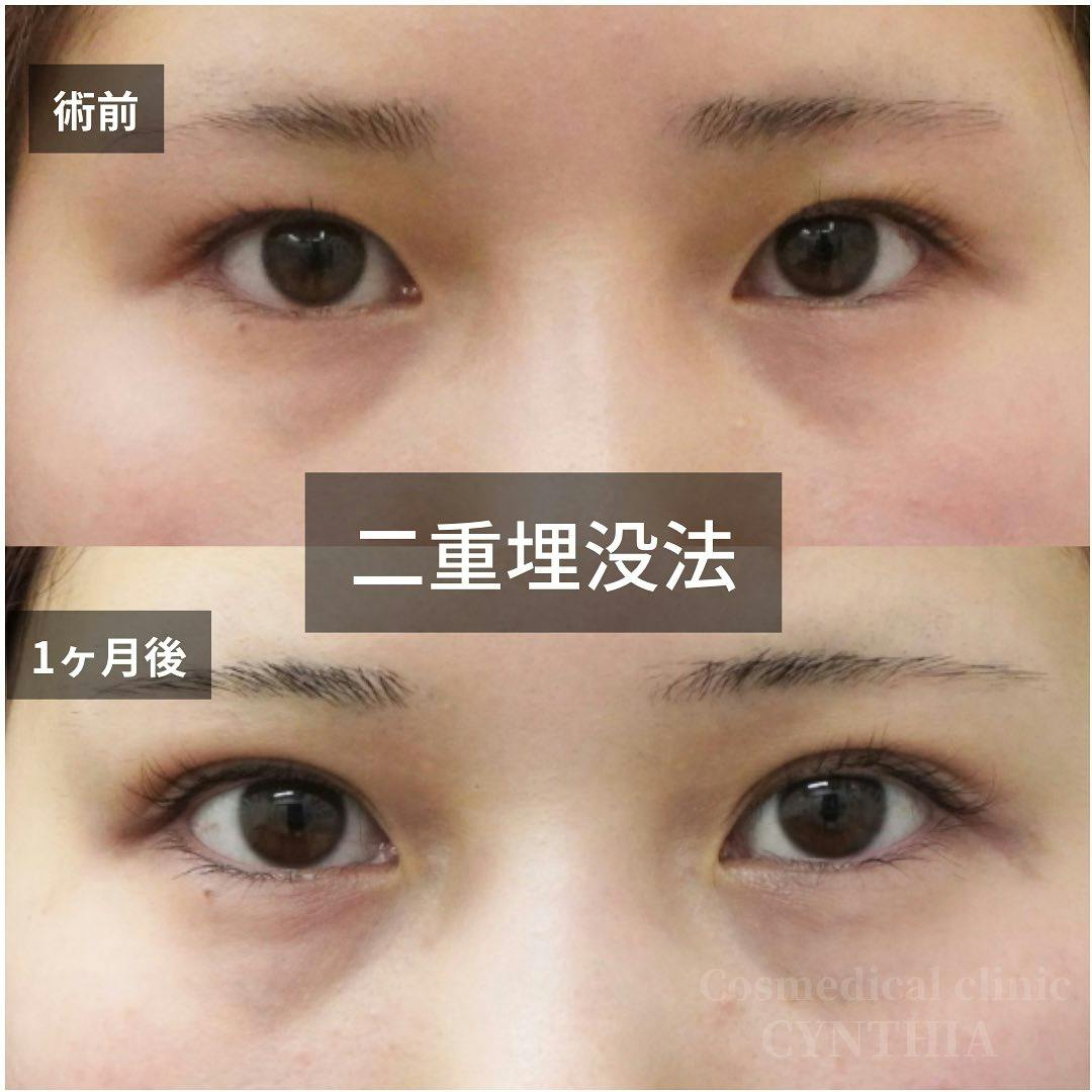 【20代女性・目元】二重埋没法_before_aftar