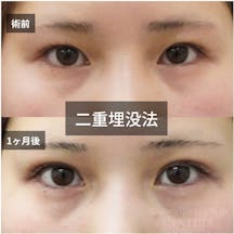 【20代女性・目元】二重埋没法_before_aftar