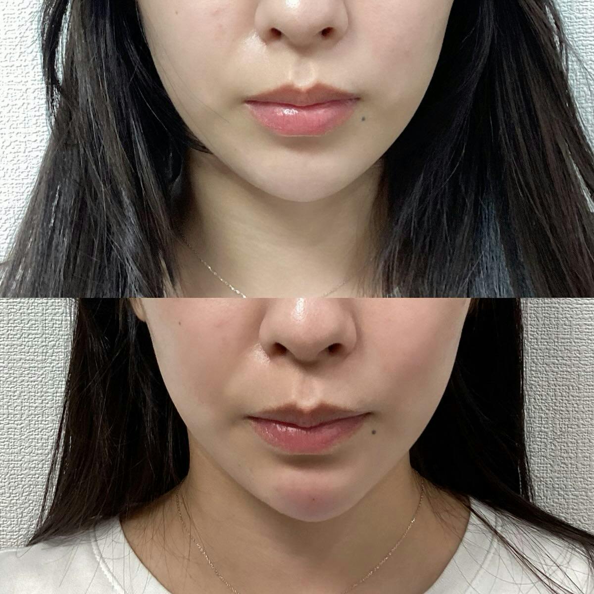【女性・顎】ヒアルロン酸(顎)_before_aftar