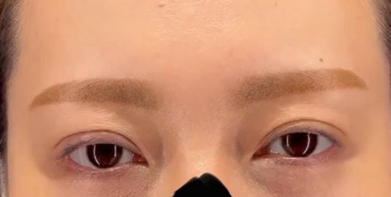 湘南美容クリニック 新橋銀座口院で切開法：眼瞼下垂を受けたふーみんさんの写真