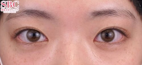 【10代女性・目元】クイックコスメティーク・トリプルNeo_before