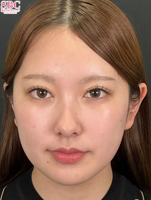 【20代女性・目元】目の下の切らないクマ・たるみ（ふくらみ）取り_after