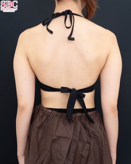 【20代女性・二の腕】Aquicell（アキーセル）脂肪吸引、根こそぎVASER脂肪吸引_before